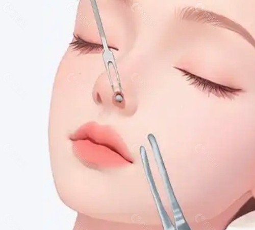 卿勇鼻畸形矫正做的好吗? 卿勇鼻畸形矫正做的好吗?