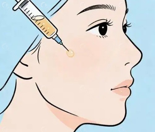 胶原灌注提升是什么?与传统填充有何不同? 胶原灌注提升是什么?与传统填充有何不同?