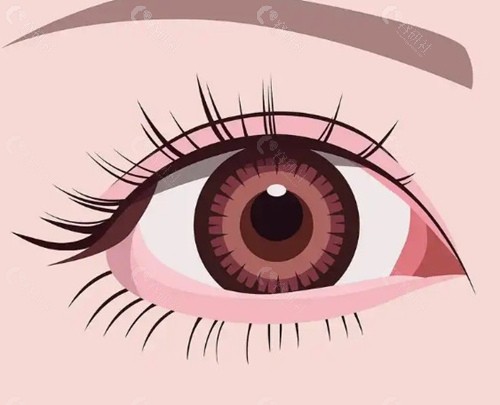 双眼皮松解成单眼皮 vs 全切松单，区别在哪？