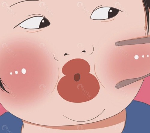 什麼是雙下巴肌肉捆綁術？它適合哪些人？