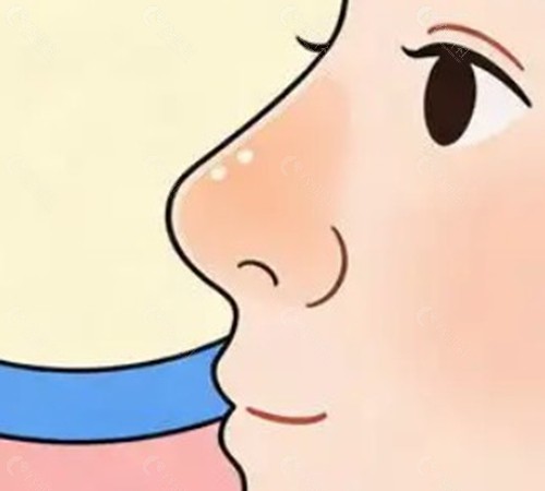 假体取出后鼻梁反而变高了正常吗？