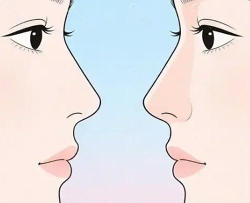 南京娄霞医生Misko埋线隆鼻怎么样？