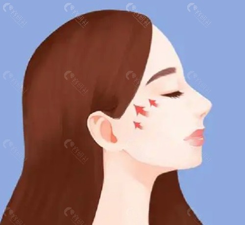 穆雄铮颧骨内推技术好吗？“稳”与“自然”是核心标签