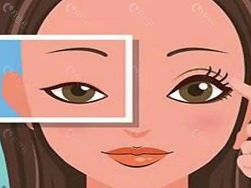 双眼皮宽改窄需要去皮吗? 双眼皮宽改窄需要去皮吗?