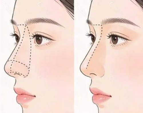 冯思阳肋骨鼻综合做的好吗? 冯思阳肋骨鼻综合做的好吗?