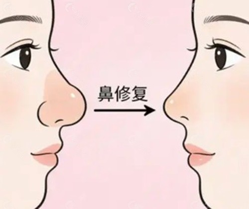 隆鼻失败三次后,鼻部面临的现实挑战与修复可行性 隆鼻失败三次后,鼻部面临的现实挑战与修复可行性