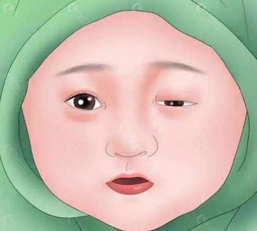 上眼睑下垂北京哪个医生做手术好 上眼睑下垂北京哪个医生做手术好