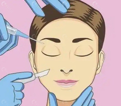 做提眉手术重庆哪位医生技术好 做提眉手术重庆哪位医生技术好