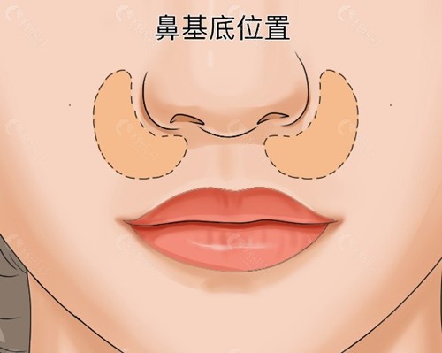 薛美思医生打濡白天使做鼻基底怎么样？