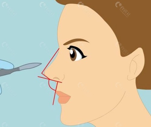 什么是液态骨雕鼻?它是如何操作的? 什么是液态骨雕鼻?它是如何操作的?