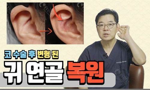 韩国普罗菲耳郑在皓院长耳朵整形