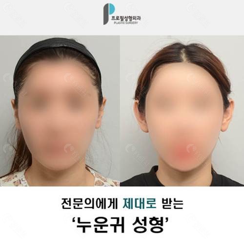 韩国profile普罗菲耳医院双耳不对称贴发耳矫正前后对比照