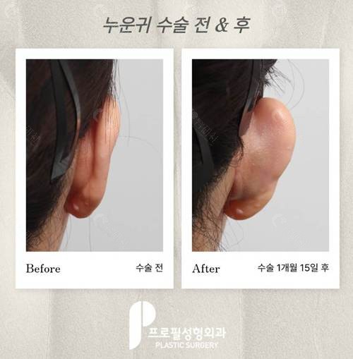 韩国普罗菲耳医院贴发耳矫正前后对比照 韩国普罗菲耳医院贴发耳矫正前后对比照