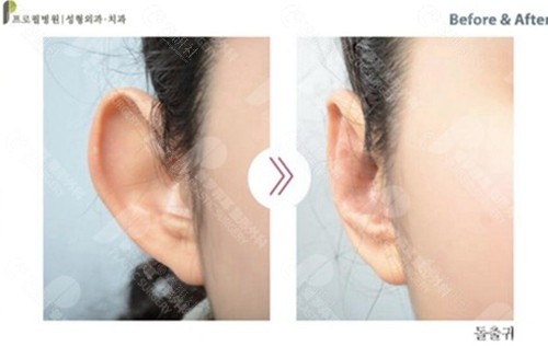 成人招风耳可以矫正吗? 成人招风耳可以矫正吗?