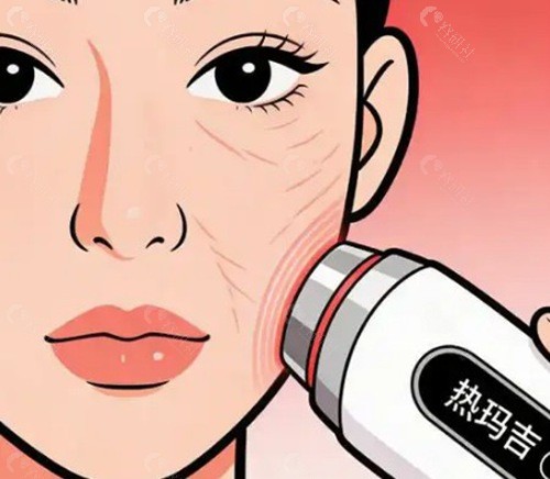岳阳热玛吉市场价格行情参考