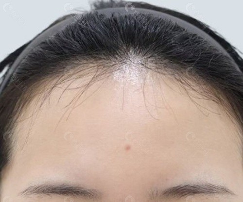 內窺鏡額頭提升,究竟算大手術還是小手術? 內窺鏡額頭提升,究竟算大手術還是小手術?