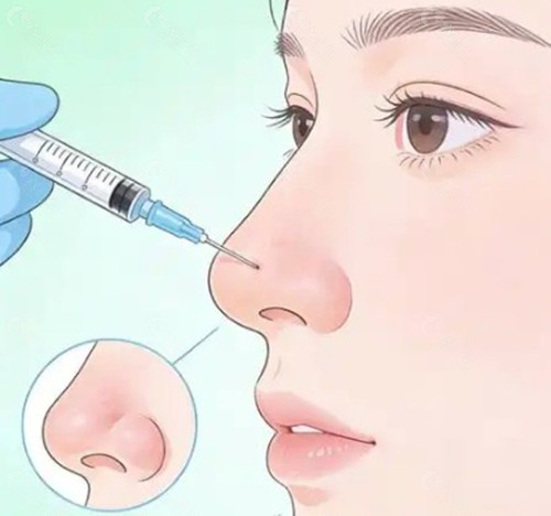 玻尿酸打鼻子，用什么牌子好？