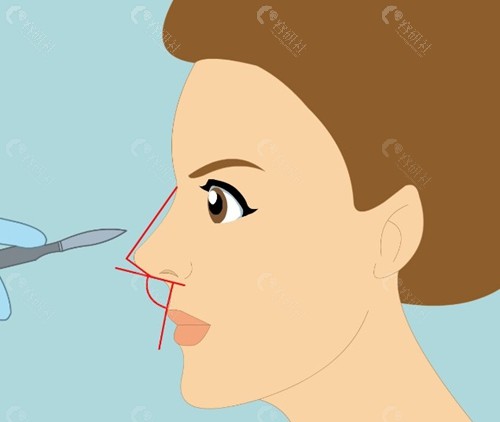 鼻头挛缩还可以恢复回来吗? 鼻头挛缩还可以恢复回来吗?