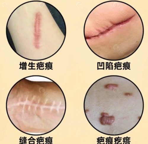佛山曙光金子疤痕修复哪位医生好? 佛山曙光金子疤痕修复哪位医生好?