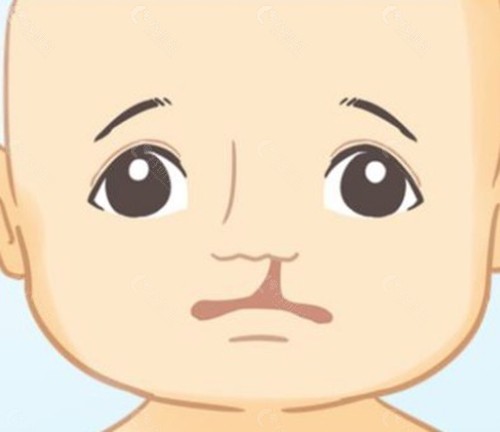 张曦医生做唇腭裂修复靠谱吗? 张曦医生做唇腭裂修复靠谱吗?