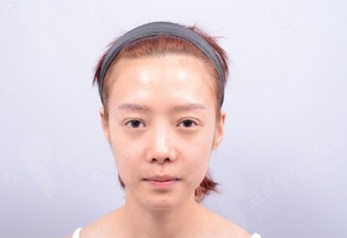 耳舒展手术后,耳轮和耳软骨能变软吗? 耳舒展手术后,耳轮和耳软骨能变软吗?