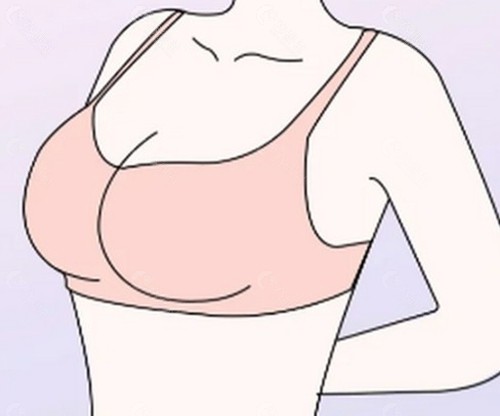 假体取出来,对乳房的伤害究竟有多大? 假体取出来,对乳房的伤害究竟有多大?